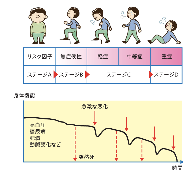 図：心不全のステージ