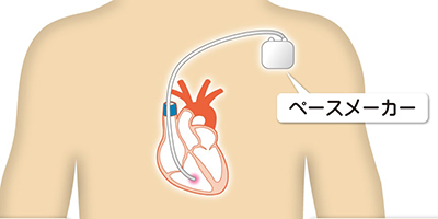 図：ペースメーカーの説明
