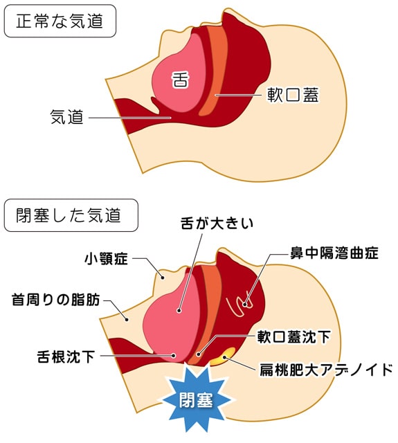 図：sasの原因